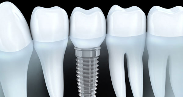 dental-bridge-or-implant-for-missing-teeth