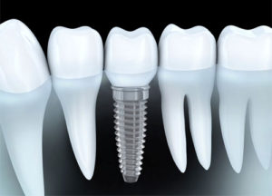 implant in chennai