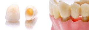 dental bridge in chennai