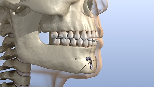 jaw surgery in chennai