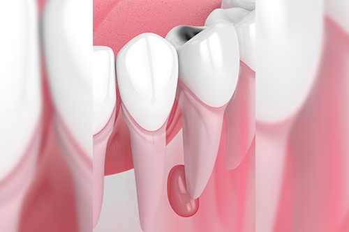 periapical surgery in chennai