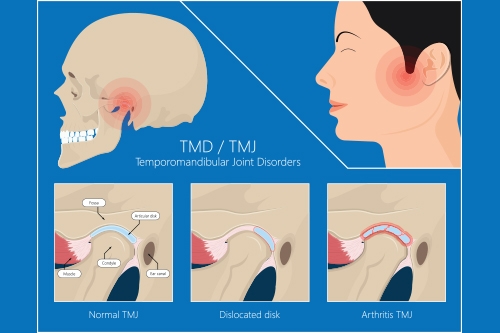 tmj disorders in chennai