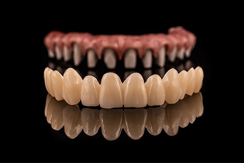 full mouth reconstruction dentist in chennai