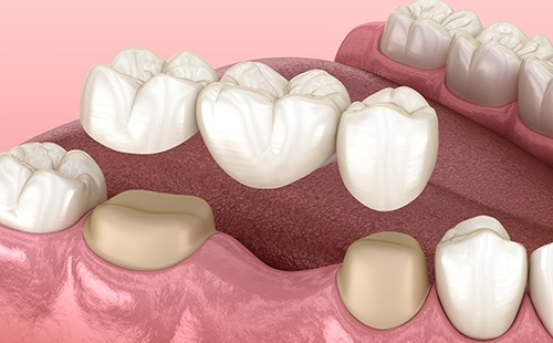 cost of dental bridge in chennai