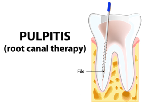 root canal treatment in chennai