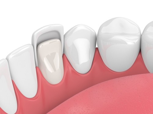 dental veneer in chennai