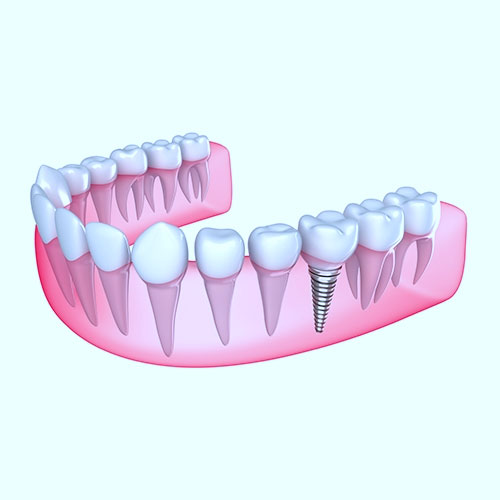 best dental implants chennai 