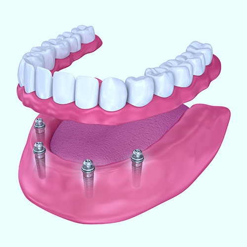 removable dentures in chennai