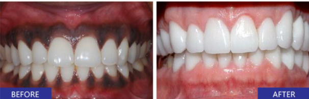 gingival depigmentation in chennai