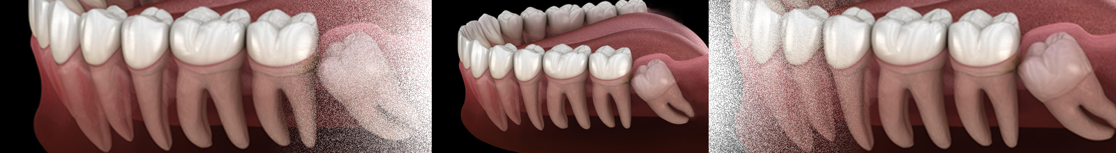  Wisdom Tooth removal