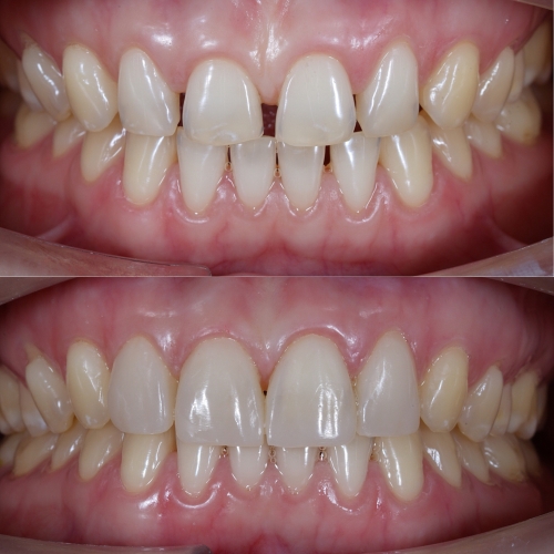 cost of dental veneer in chennai