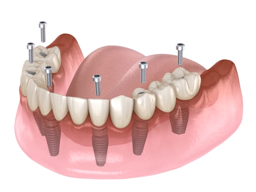 fixed hybrid denture in chennai