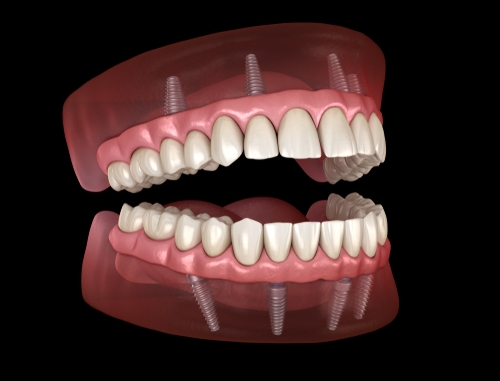 keyhole implant in chennai