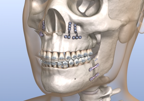 maxillary surgery in chennai