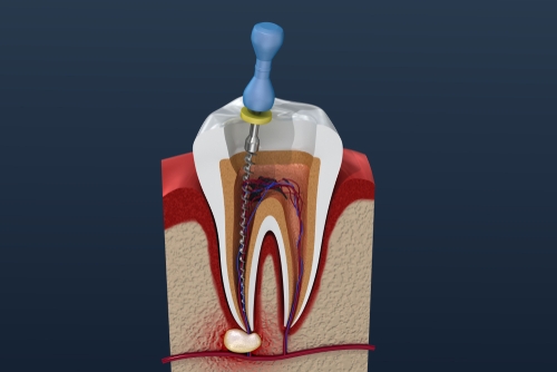 cost of root canal treatment in chennai