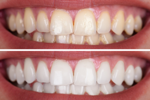 best teeth whitening chennai 