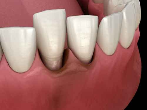 avulsed tooth management in chennai
