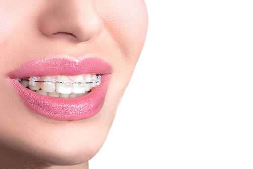 ceramic braces in chennai