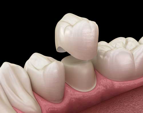 dental crowns in chennai