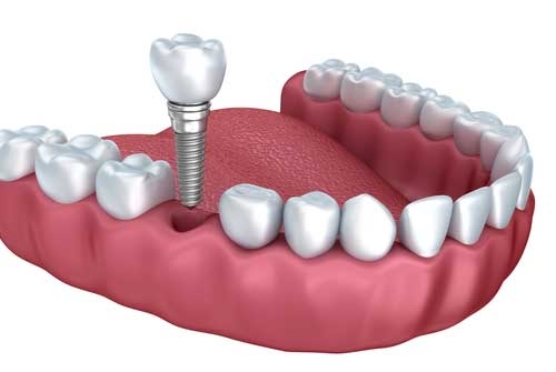 full mouth dental implants in chennai