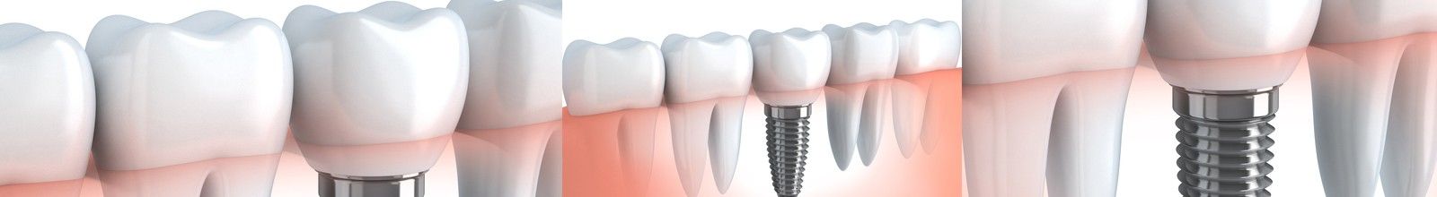 Full mouth fixed ceramic teeth ( All-on-6 / All-on-8)