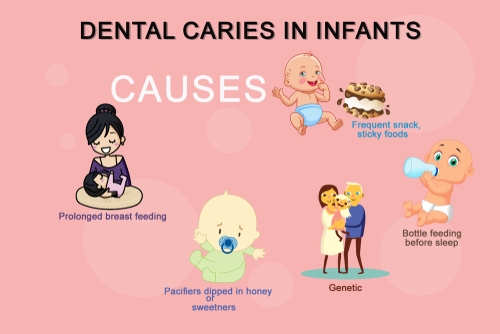 nursing bottle caries in chennai