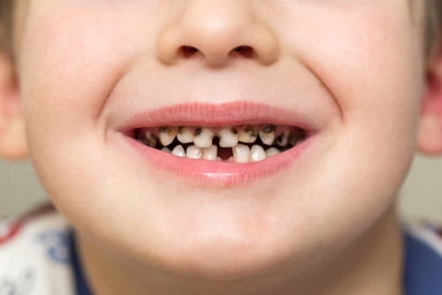 early childhood caries in chennai