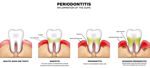 periodontitis in chennai