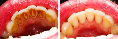 periodontitis cost in chennai