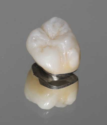tooth crown in chennai