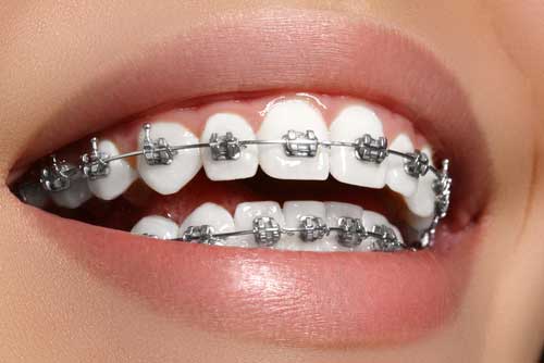 metal braces cost in chennai