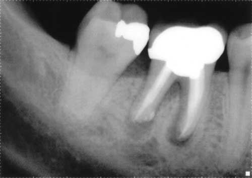 failed root canal treatment in chennai