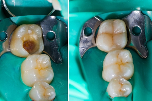 tooth colored restoration in chennai