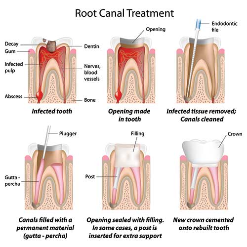 root canal treatment in chennai